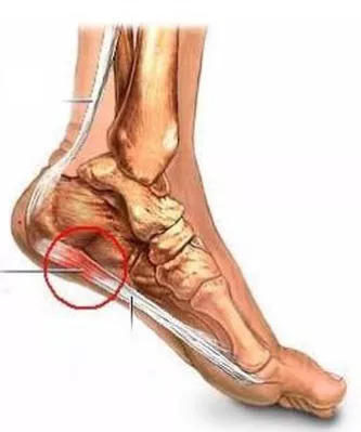 исследования 3D-печати индивидуальной пяточной стельки 1