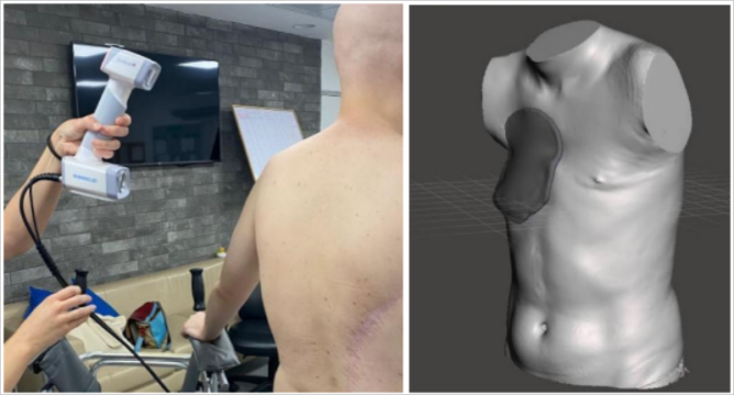 Сканирование с помощью EinScan H (слева); 3D-модель тела пациента (справа)