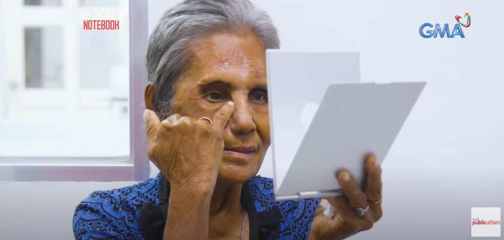 Лицевой протез