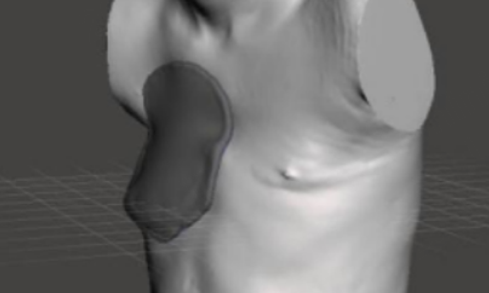 Грудной протез